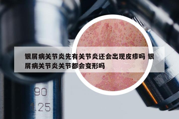 銀屑病關(guān)節(jié)炎先有關(guān)節(jié)炎還會出現(xiàn)皮疹嗎 銀屑病關(guān)節(jié)炎關(guān)節(jié)都會變形嗎