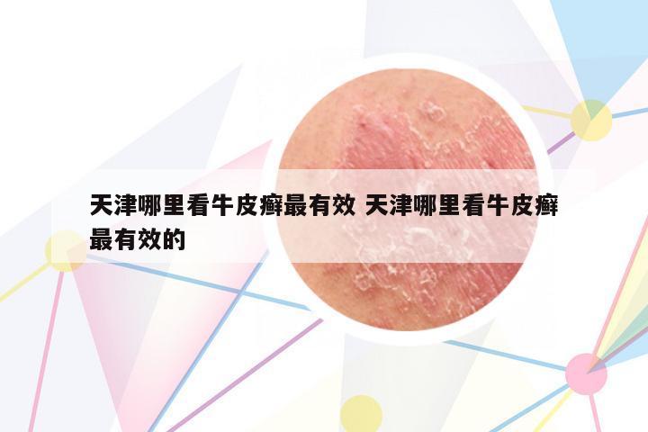 天津哪里看牛皮癬最有效 天津哪里看牛皮癬最有效的