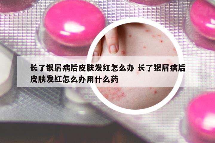 長了銀屑病后皮膚發(fā)紅怎么辦 長了銀屑病后皮膚發(fā)紅怎么辦用什么藥
