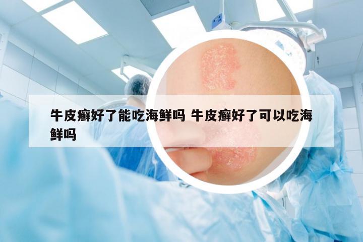 牛皮癬好了能吃海鮮嗎 牛皮癬好了可以吃海鮮嗎