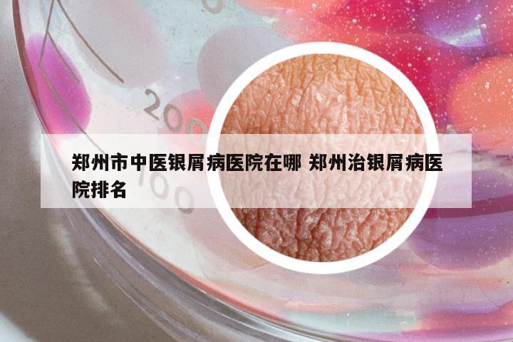 鄭州市中醫(yī)銀屑病醫(yī)院在哪 鄭州治銀屑病醫(yī)院排名