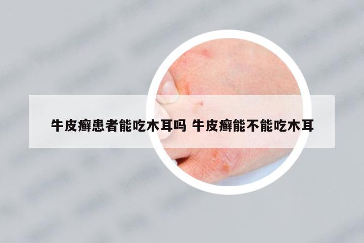 牛皮癬患者能吃木耳嗎 牛皮癬能不能吃木耳