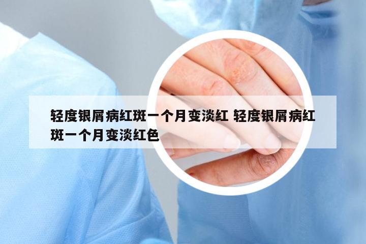 輕度銀屑病紅斑一個月變淡紅 輕度銀屑病紅斑一個月變淡紅色