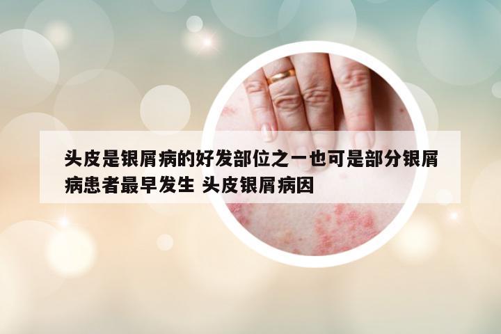 頭皮是銀屑病的好發(fā)部位之一也可是部分銀屑病患者最早發(fā)生 頭皮銀屑病因