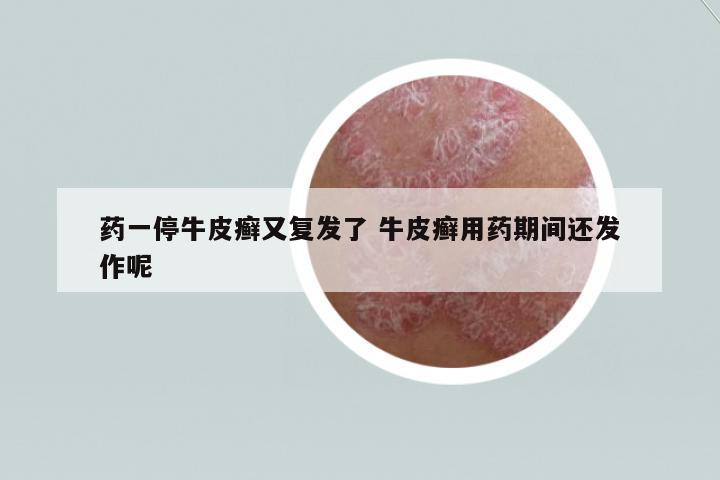 藥一停牛皮癬又復(fù)發(fā)了 牛皮癬用藥期間還發(fā)作呢