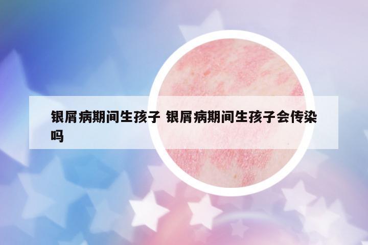 銀屑病期間生孩子 銀屑病期間生孩子會傳染嗎
