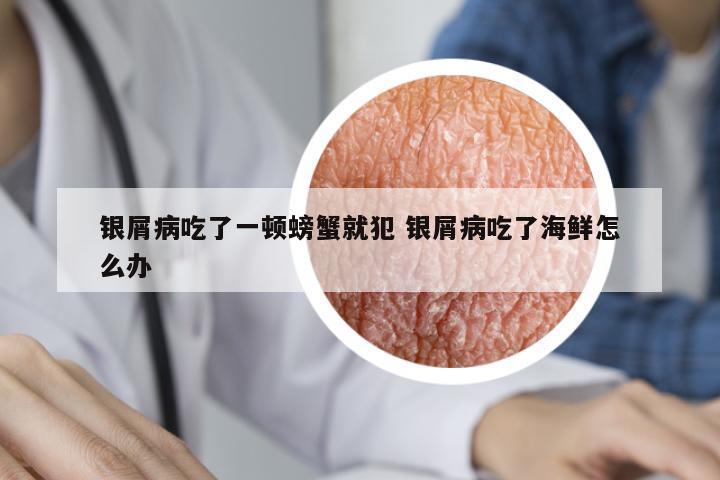銀屑病吃了一頓螃蟹就犯 銀屑病吃了海鮮怎么辦