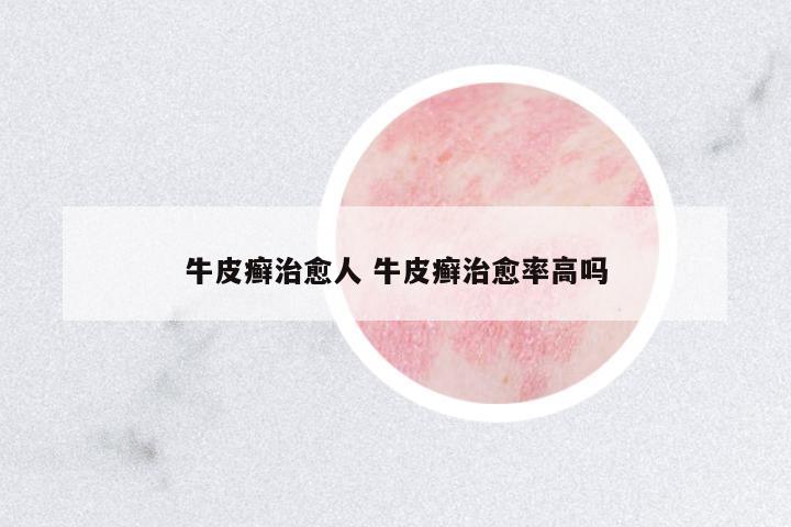 牛皮癬治愈人 牛皮癬治愈率高嗎