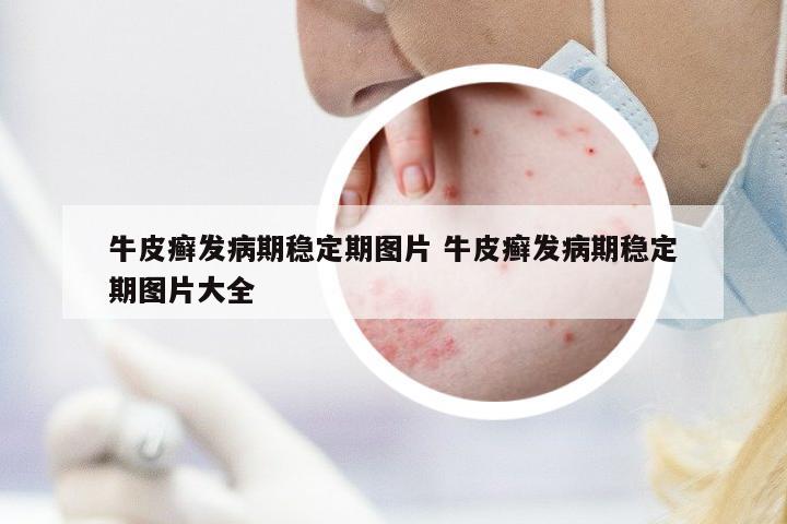 牛皮癬發(fā)病期穩(wěn)定期圖片 牛皮癬發(fā)病期穩(wěn)定期圖片大全