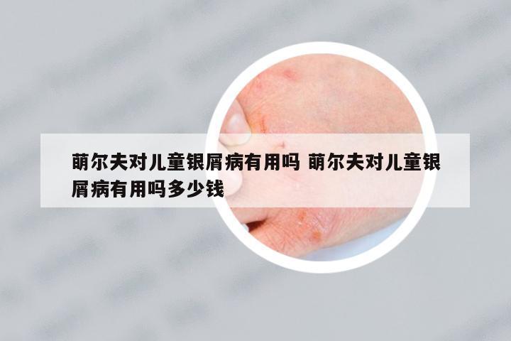 萌爾夫對兒童銀屑病有用嗎 萌爾夫對兒童銀屑病有用嗎多少錢
