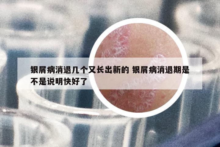銀屑病消退幾個又長出新的 銀屑病消退期是不是說明快好了