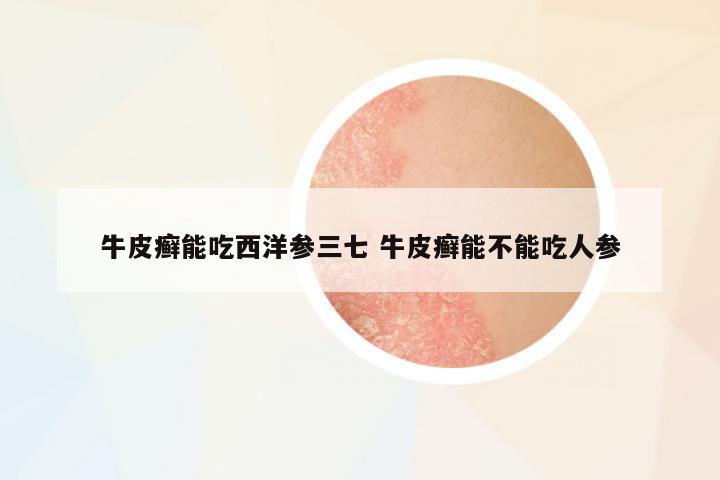牛皮癬能吃西洋參三七 牛皮癬能不能吃人參