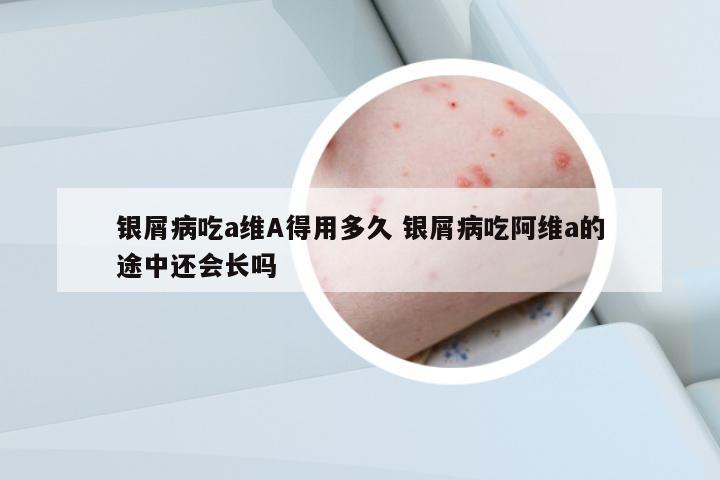 銀屑病吃a維A得用多久 銀屑病吃阿維a的途中還會長嗎