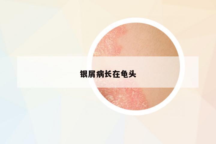 銀屑病長(zhǎng)在龜頭