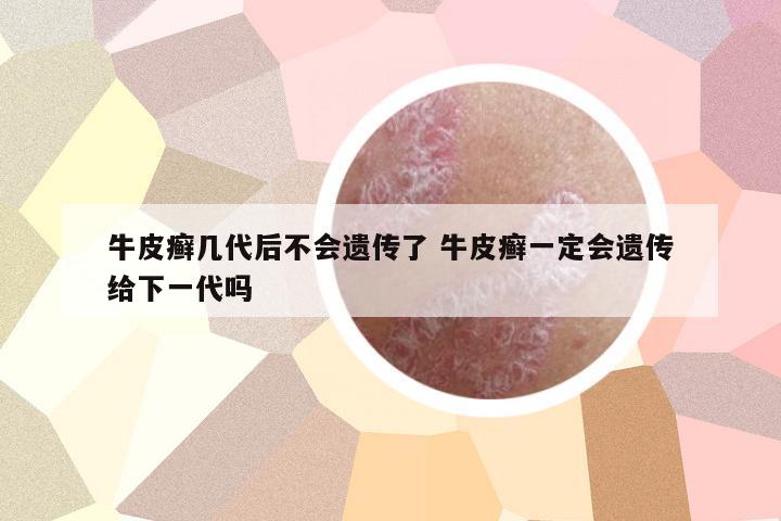 牛皮癬幾代后不會遺傳了 牛皮癬一定會遺傳給下一代嗎