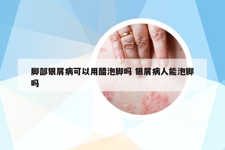 腳部銀屑病可以用醋泡腳嗎 銀屑病人能泡腳嗎