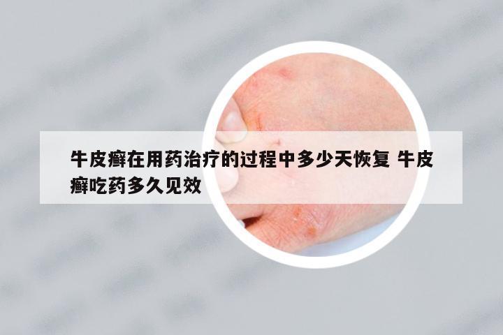 牛皮癬在用藥治療的過(guò)程中多少天恢復(fù) 牛皮癬吃藥多久見(jiàn)效
