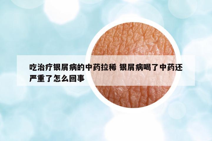吃治療銀屑病的中藥拉稀 銀屑病喝了中藥還嚴重了怎么回事