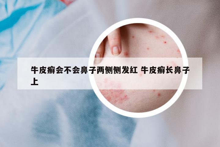 牛皮癬會不會鼻子兩側(cè)側(cè)發(fā)紅 牛皮癬長鼻子上