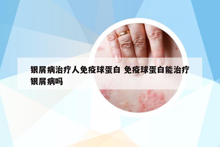 銀屑病治療人免疫球蛋白 免疫球蛋白能治療銀屑病嗎