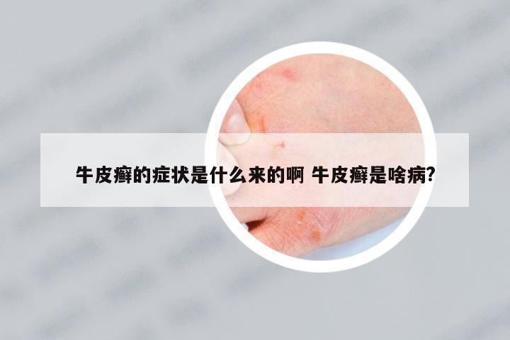牛皮癬的癥狀是什么來的啊 牛皮癬是啥病?