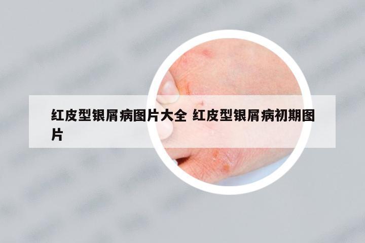 紅皮型銀屑病圖片大全 紅皮型銀屑病初期圖片