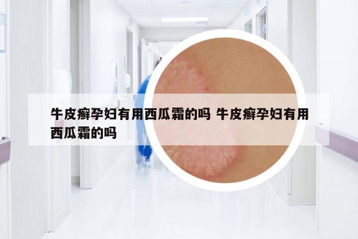 牛皮癬孕婦有用西瓜霜的嗎 牛皮癬孕婦有用西瓜霜的嗎
