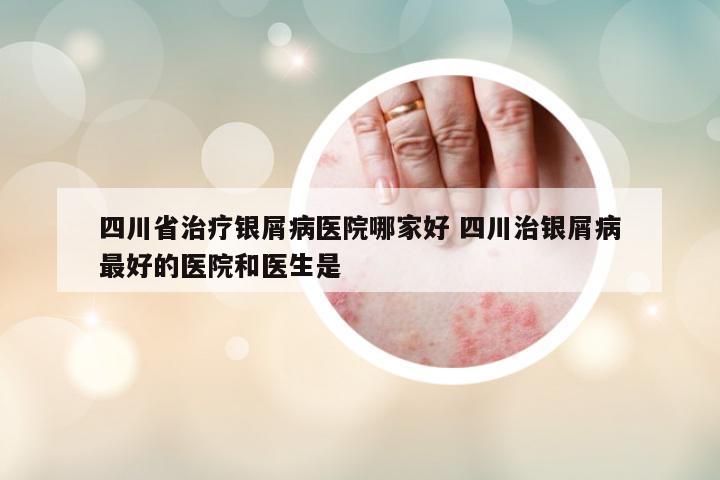 四川省治療銀屑病醫(yī)院哪家好 四川治銀屑病最好的醫(yī)院和醫(yī)生是