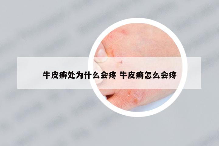 牛皮癬處為什么會疼 牛皮癬怎么會疼