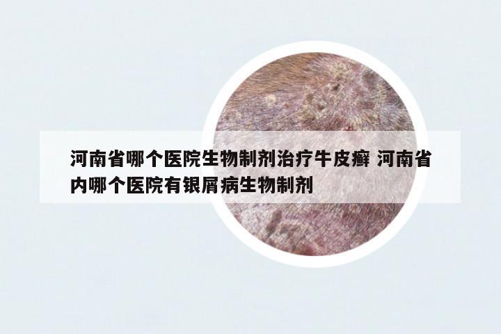 河南省哪個(gè)醫(yī)院生物制劑治療牛皮癬 河南省內(nèi)哪個(gè)醫(yī)院有銀屑病生物制劑