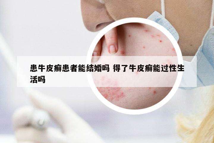 患牛皮癬患者能結(jié)婚嗎 得了牛皮癬能過(guò)性生活嗎