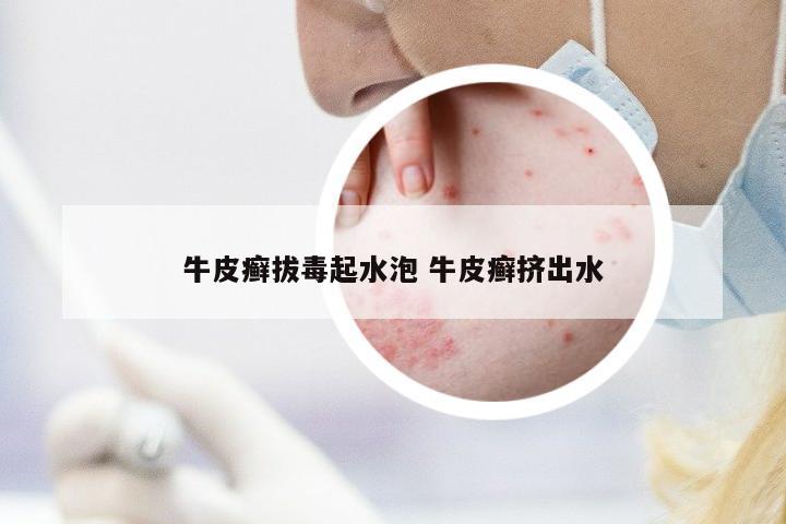 牛皮癬拔毒起水泡 牛皮癬擠出水