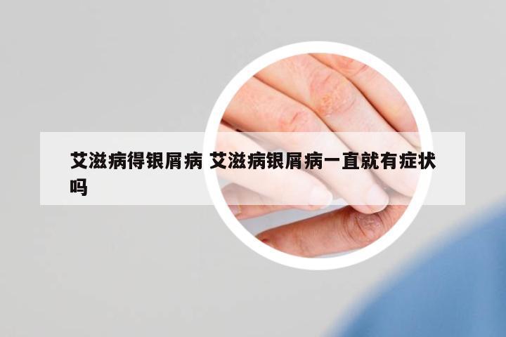 艾滋病得銀屑病 艾滋病銀屑病一直就有癥狀嗎