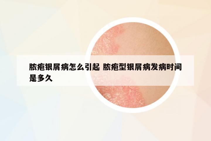 膿皰銀屑病怎么引起 膿皰型銀屑病發(fā)病時間是多久