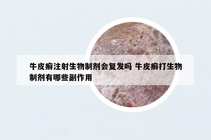 牛皮癬注射生物制劑會復(fù)發(fā)嗎 牛皮癬打生物制劑有哪些副作用