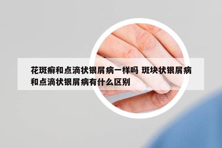 花斑癬和點滴狀銀屑病一樣嗎 斑塊狀銀屑病和點滴狀銀屑病有什么區(qū)別