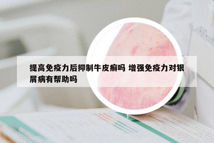 提高免疫力后抑制牛皮癬嗎 增強(qiáng)免疫力對銀屑病有幫助嗎