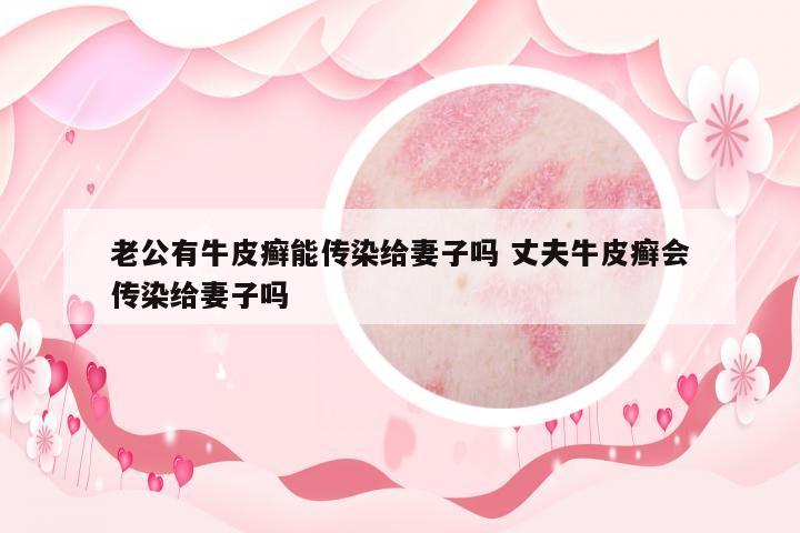 老公有牛皮癬能傳染給妻子嗎 丈夫牛皮癬會傳染給妻子嗎