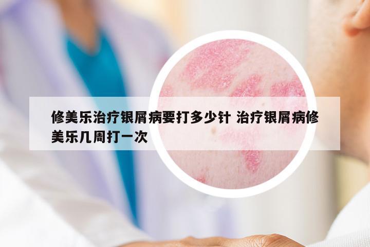 修美樂治療銀屑病要打多少針 治療銀屑病修美樂幾周打一次