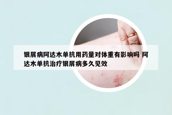 銀屑病阿達(dá)木單抗用藥量對(duì)體重有影響嗎 阿達(dá)木單抗治療銀屑病多久見(jiàn)效