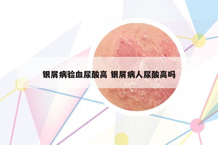 銀屑病驗血尿酸高 銀屑病人尿酸高嗎