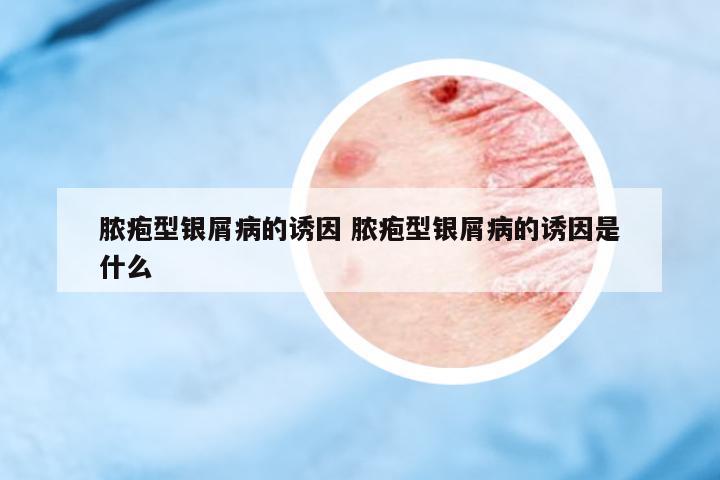 膿皰型銀屑病的誘因 膿皰型銀屑病的誘因是什么