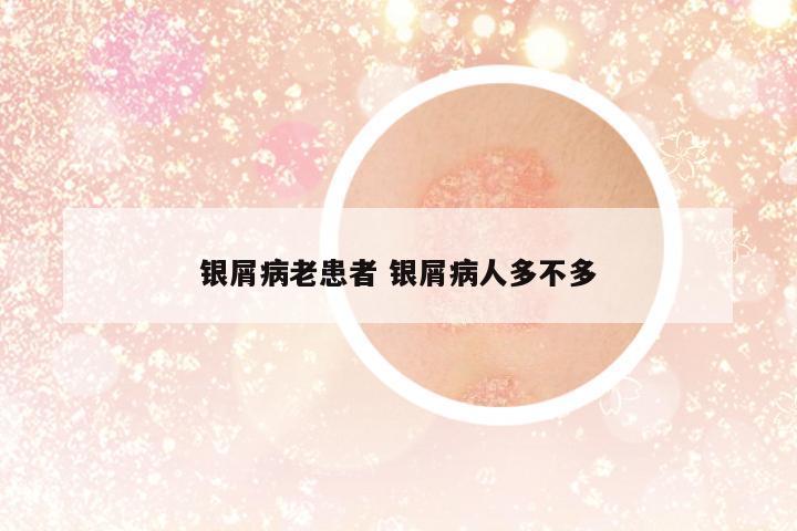 銀屑病老患者 銀屑病人多不多
