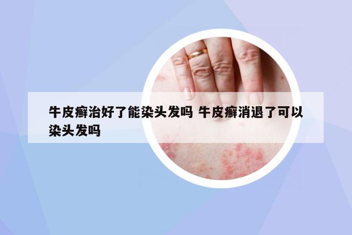 牛皮癬治好了能染頭發(fā)嗎 牛皮癬消退了可以染頭發(fā)嗎