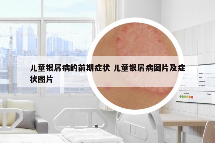 兒童銀屑病的前期癥狀 兒童銀屑病圖片及癥狀圖片