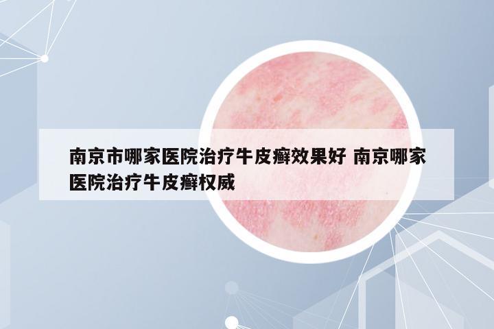 南京市哪家醫(yī)院治療牛皮癬效果好 南京哪家醫(yī)院治療牛皮癬權(quán)威