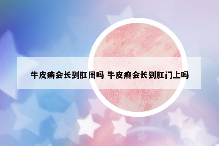 牛皮癬會(huì)長(zhǎng)到肛周嗎 牛皮癬會(huì)長(zhǎng)到肛門上嗎