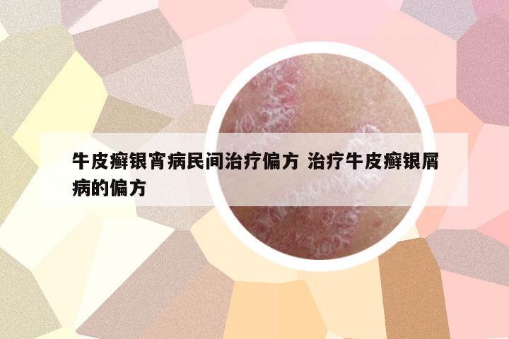 牛皮癬銀宵病民間治療偏方 治療牛皮癬銀屑病的偏方