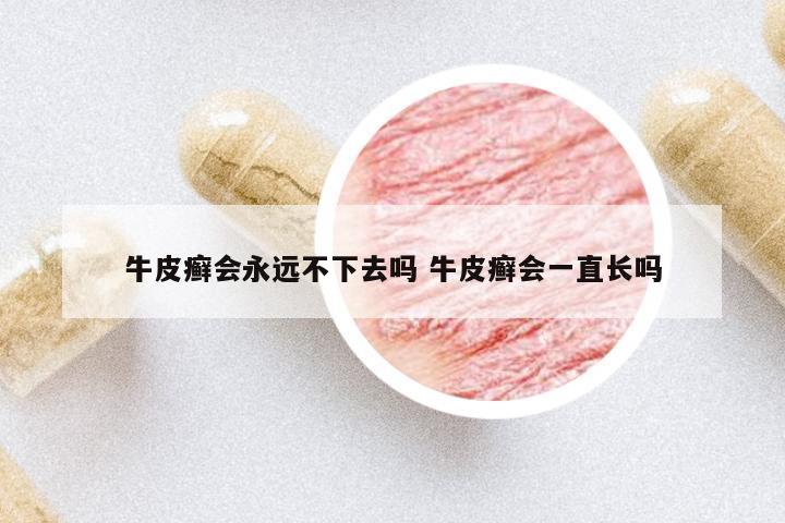 牛皮癬會永遠(yuǎn)不下去嗎 牛皮癬會一直長嗎