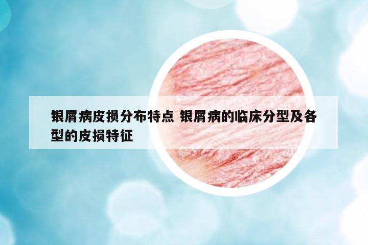 銀屑病皮損分布特點(diǎn) 銀屑病的臨床分型及各型的皮損特征
